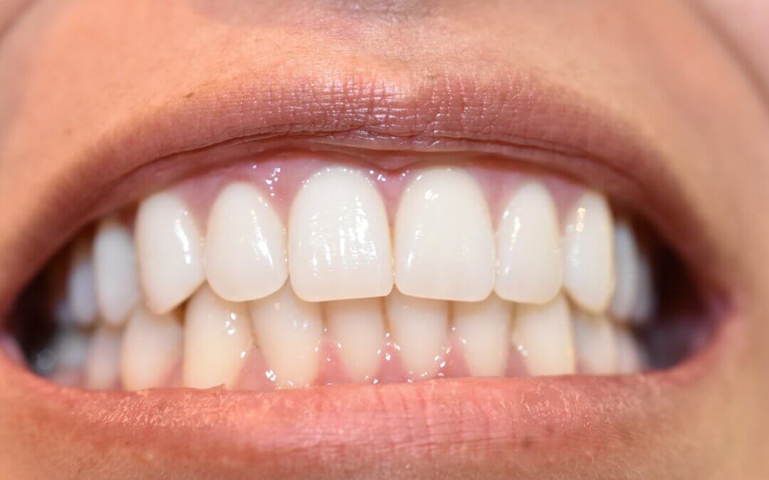 Ultimate Guide to Teeth Whitening Options