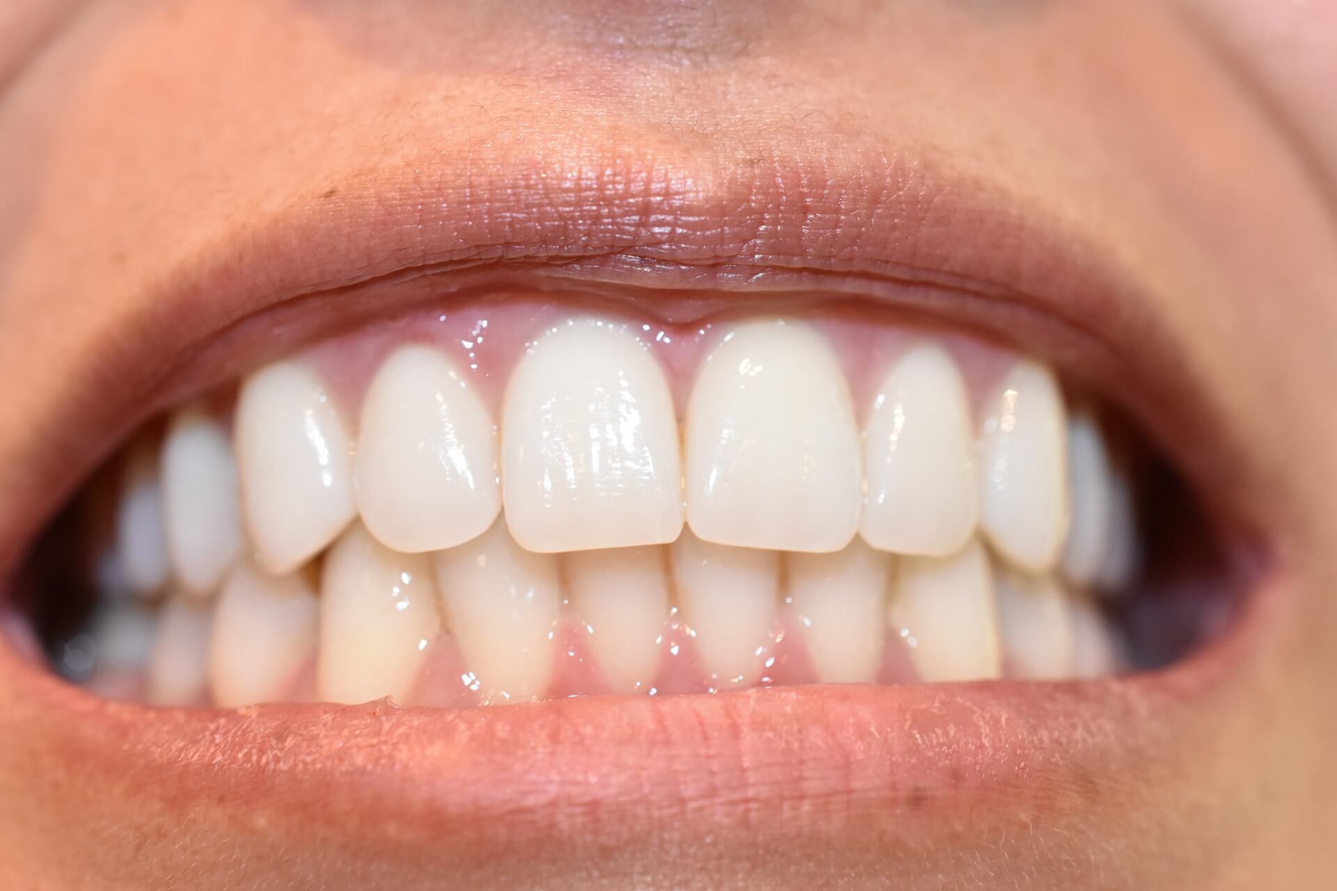 The Ultimate Guide to Teeth Whitening and Options